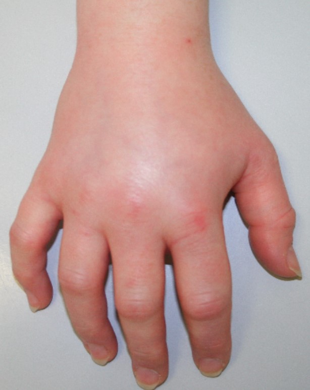 Akutes Ödem des Handrückens bei einer Patientin mit einem Hereditären Angioödem Typ II 