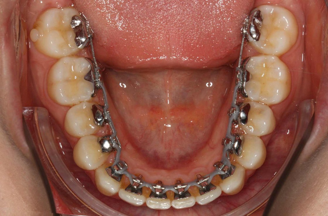 bbildung: Korrektur Zahnfehlstellungen mit Brackets