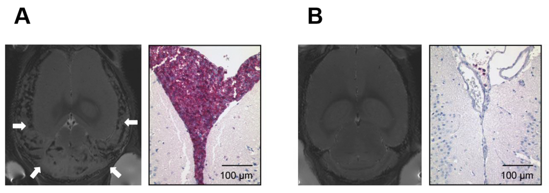 Central nervous system (CNS) leukemia modeled in the NOD/SCID/huALL system. Figure A: Massive meningeal infiltration with human ALL cells in NMRI scan analysis (left panel, white arrows indicate enlarged meninges) and immunohistochemistry (right panel, purple: human B-cell precursor cells, anti-human CD10 staining; and figure B: absence of meningeal manifestation in a CNS negative ALL sample.