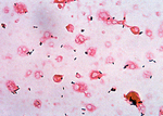Listeria monocytogenes in Blutkultur