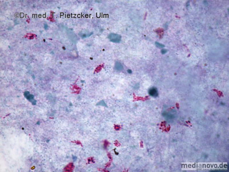 Mycobacterium tuberculosis (Ziehl-Neelsen-Färbung)