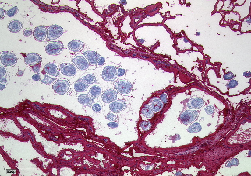 Alveoläre Echinokokkose
