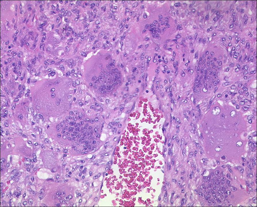 Riesenzelltumor des Knochens