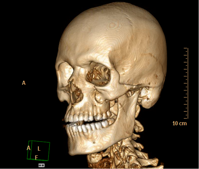Skelett Schädel Jochbeinkomplexbruch