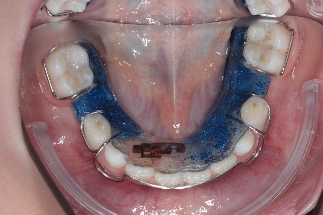 Abbildung: Milchgebiss oder in der frühen Phase des Zahnwechsels
