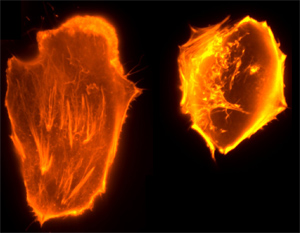 Two glioblastoma cells. Actin was stained with TRIC-phalloidin. The left glioblastoma cell clearly exhibits a well-structured cytoskeleton. In the right cell, a signalling pathway has been blocked, which hitherto had not been considered to be connected with cell organization and motility. The destruction of F-actin fibres can clearly be seen.