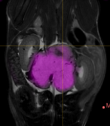 A neuroblastoma that developed in a MYCN-transgenic mouse haploid for BIRC5 avidly takes up 18F-FDG (magenta) because of its strong Warburg effect. Shown is a MRI/PET fusion image.