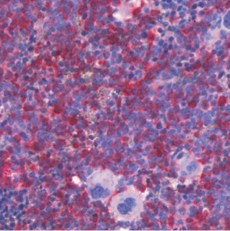 Oncolytic measles virus (red) in ALL cells in the bone marrow of mice with patient-derived ALL xenotransplants after systemic virus injection.