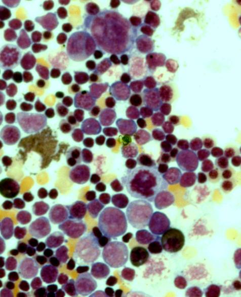 Knochenmark eines Kindes mit schwerem, kombinierten Immundefekt (SCID) mit Adenylatkinase 2 Mangel. Knochenmark eines Kindes mit schwerem, kombinierten Immundefekt (SCID) mit Adenylatkinase 2 Mangel.