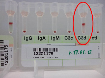 Kälteaglutininerkrankung (CAD) Kälteaglutininerkrankung (CAD)