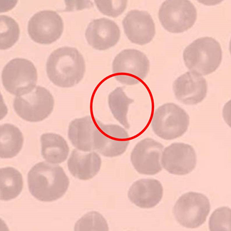 Thrombotisch-Thrombozytopenische Purpura (TTP) Thrombotisch-Thrombozytopenische Purpura (TTP)