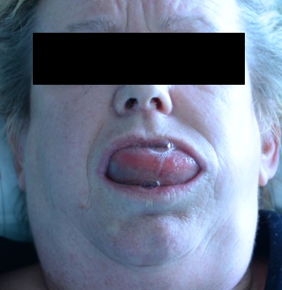 Akutes Zungenödem bei einer Patientin mit einem Hereditären Angioödem Typ I Akutes Zungenödem bei einer Patientin mit einem Hereditären Angioödem Typ I