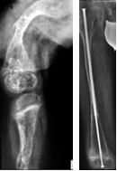 Osteogenesis imperfecta Osteogenesis imperfecta