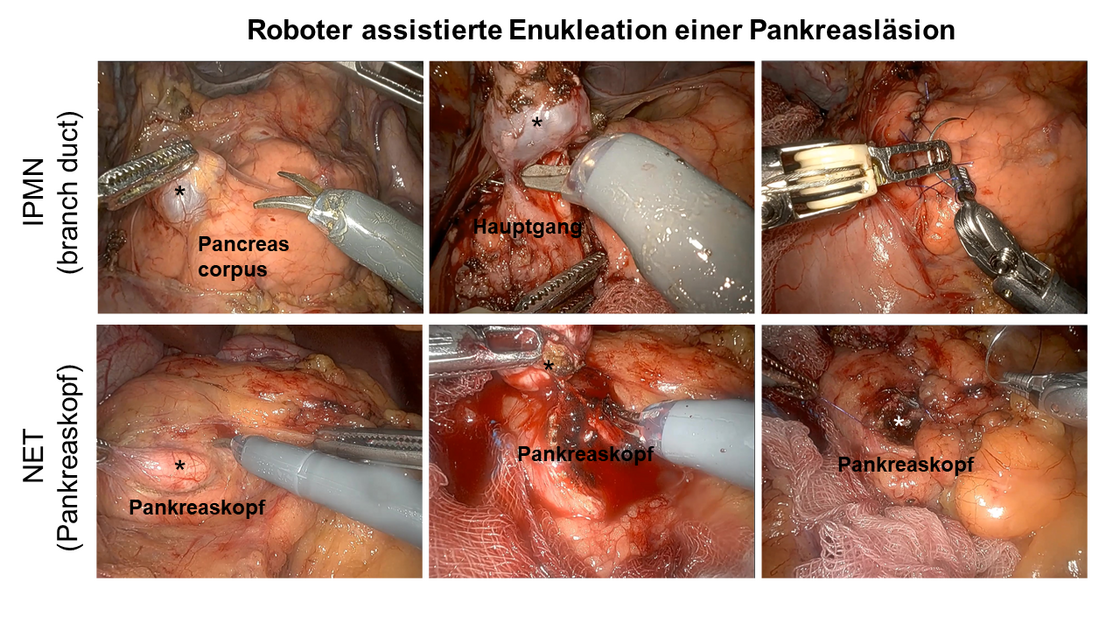 Bilder einer Roboter-assistierten Enukleation