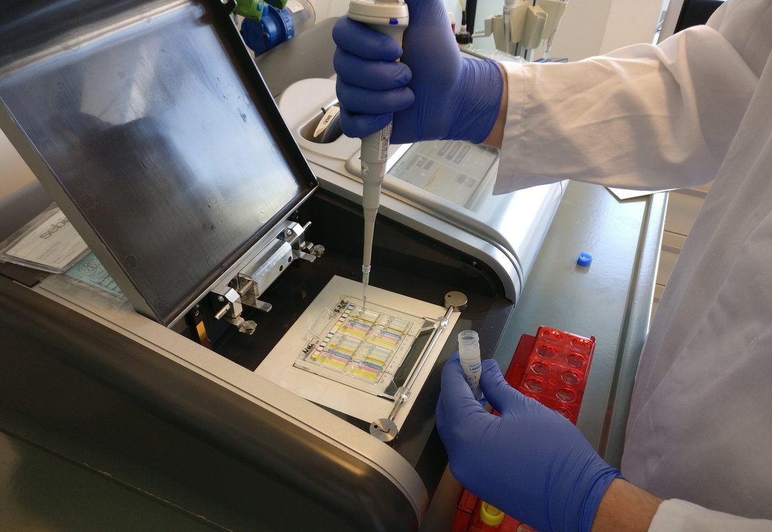 Ein Mitarbeiter pipettiert Probe in eine Schablone des Gerätes für die Immunfixation.