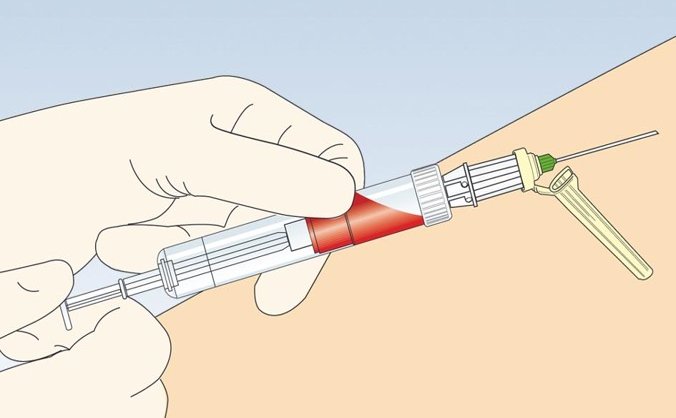Bild von einer Blutabnahme in der Armbeuge.