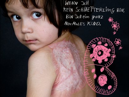 Tag des brandverletzten Kindes. Foto: Paulinchen e.V., Gabriela Acklin