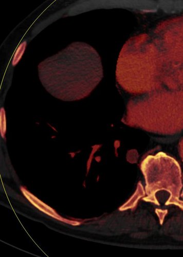 CT-Abbildung eines Tumors