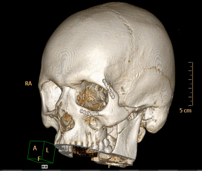 Skelett Schädel Jochbeinreposition