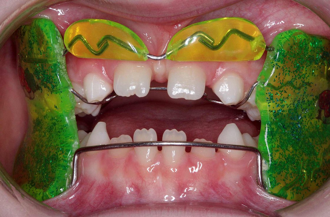 Abbildung: bunte herausnehmbare Zahnspange