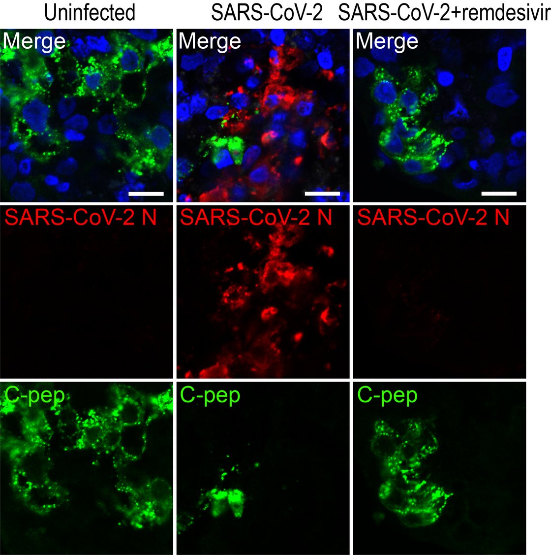 Human pancreatic islets infected with SARS-CoV-2, stain positive for SARS-CoV-2 N protein. Treatment with remdesivir, a polymerase inhibitor with potent in vitro anti-SARS-CoV-2 activity, efficiently blocked viral infection.