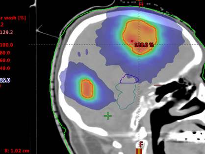 Mit der HyperArc-Strahlentherapie  können einzelne, aber auch mehrere Hirnmetastasen gleichzeitig stereotaktisch innerhalb von etwa 30 Minuten bestrahlt werden. Darstellung der Bestrahlung von zwei Hirnmetastasen (auf dem Bild orange dargestellt, grün der Anteil des Hirns, der noch 60 bis 80 Prozent der Dosis erhält). Quelle: Universitätsklinikum Ulm