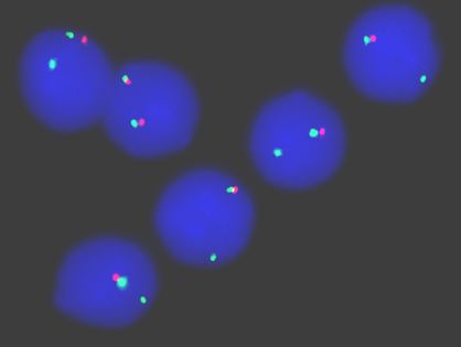 Leukämiezellen, in deren Zellkern sich lediglich ein rotes Signal findet, haben einen Teil des Chromosoms 17 verloren. Das führt zu Resistenz gegen Chemotherapie und Zelltod.