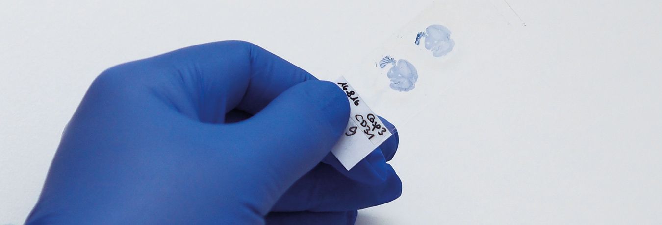 The gloved hand of a researcher holds a specimen slide with two glioblastoma sections