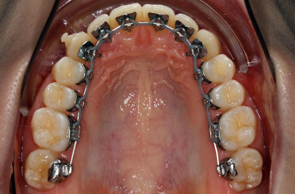 bbildung: Korrektur Zahnfehlstellungen mit Brackets