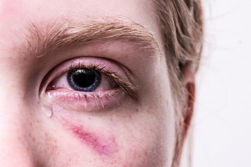 Blaues Auge