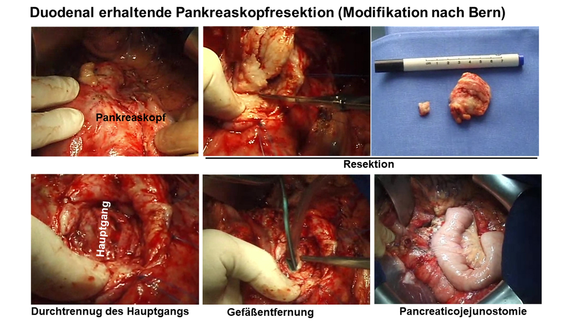 Bilder einer duodenal erhaltenden Pankreaskopfresektion