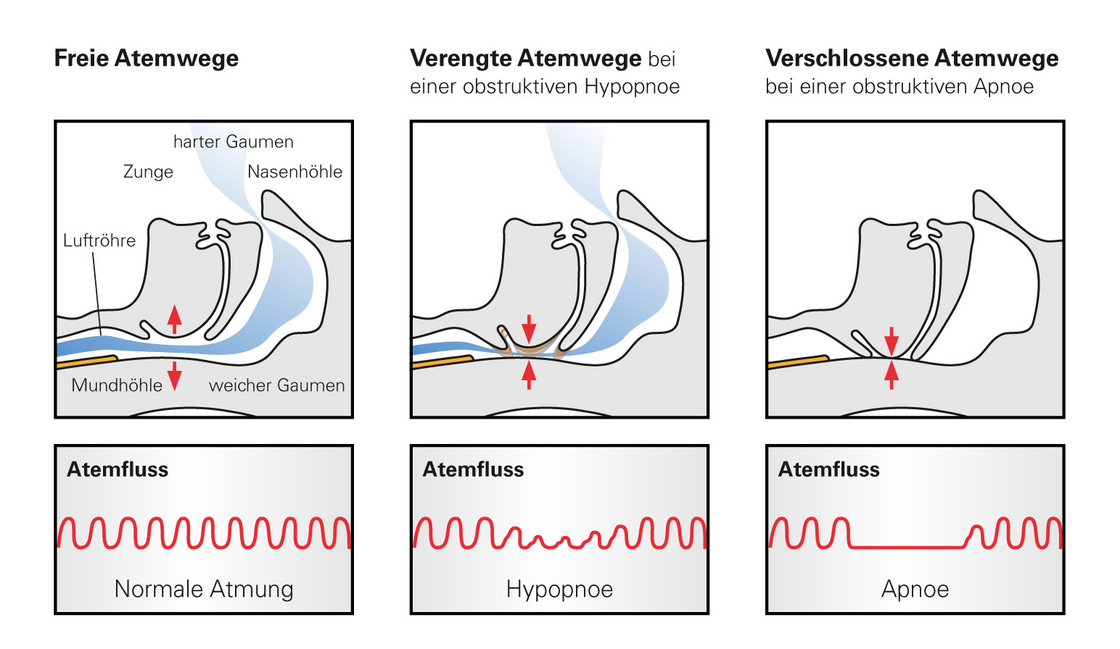 Normale und pathologische Atemkurven im Schlaf