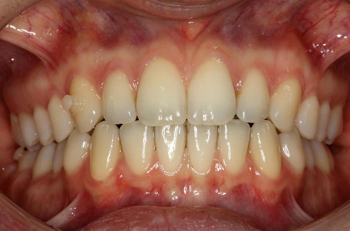 bbildung: Korrektur Zahnfehlstellungen