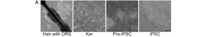 microskopic representation: Reprogramming outline of plucked human hair (with outer root sheath (ORS)) keratinocytes (ker) from a patient with CF towards iPSCs.