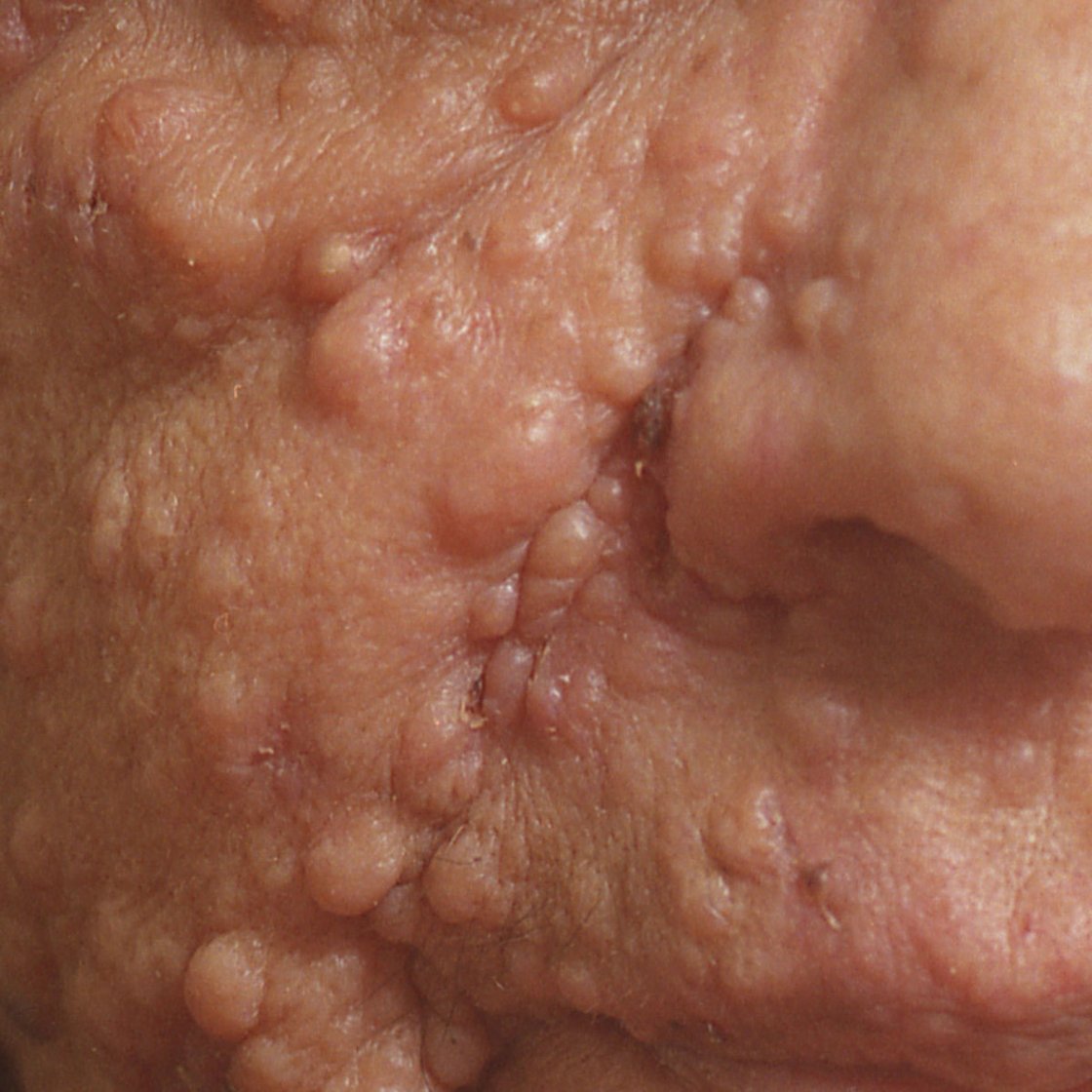 Neurofibromatose