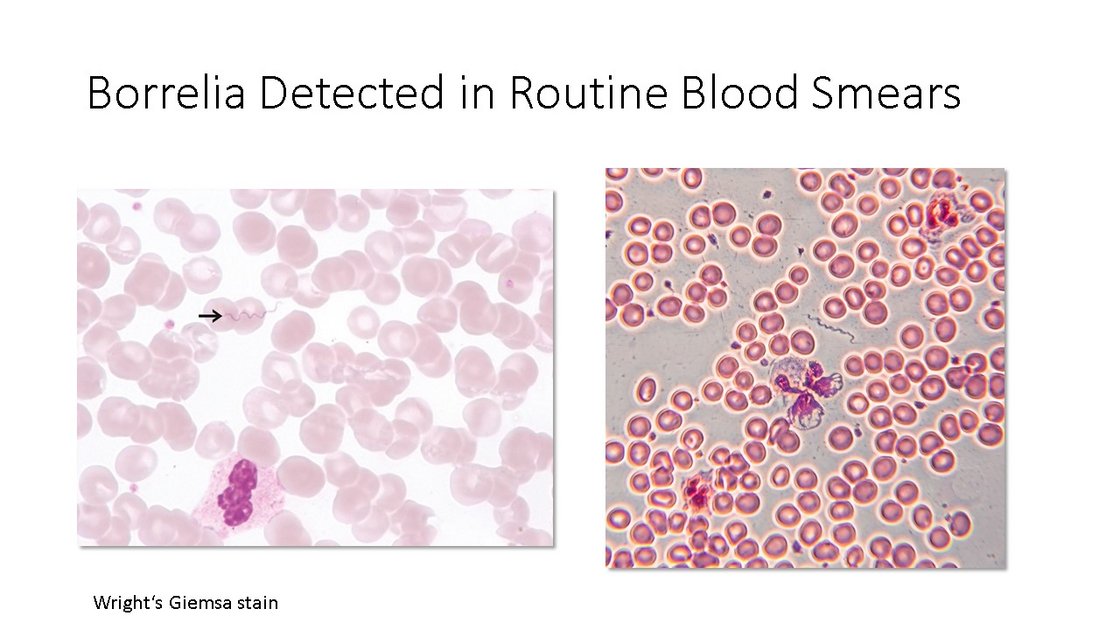 Studies in chronic and persistent Lyme Borreliosis: Borrelia detected in routine blood smears