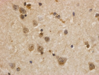Verklumpung des Huntington-Eiweißes_Abb: Dr. Katrin Lindenberg, Neurologie Universitätsklinikum Ulm