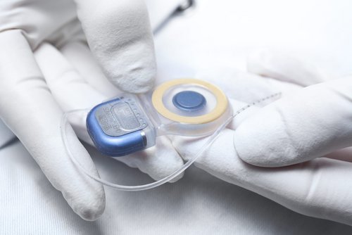 Cochlear Implantat (Foto: UK Ulm)
