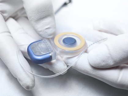 Cochlear Implantat (Foto: UK Ulm)