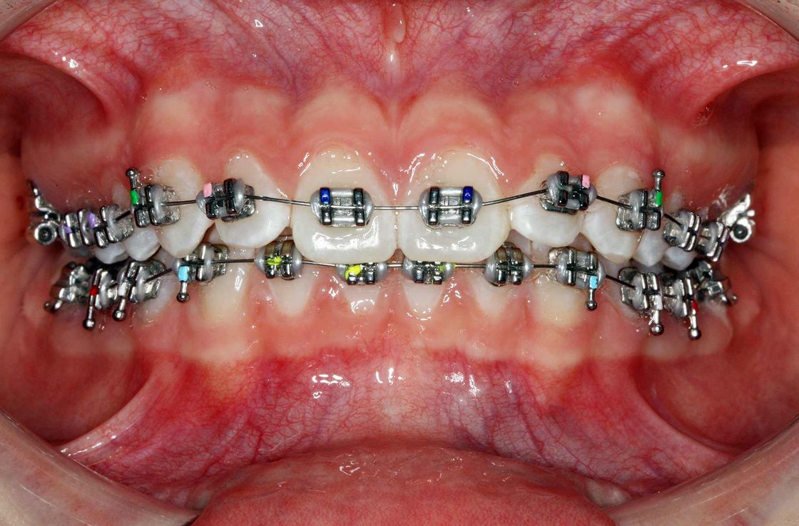 Abbildung: Beispiel von Metallbrackets