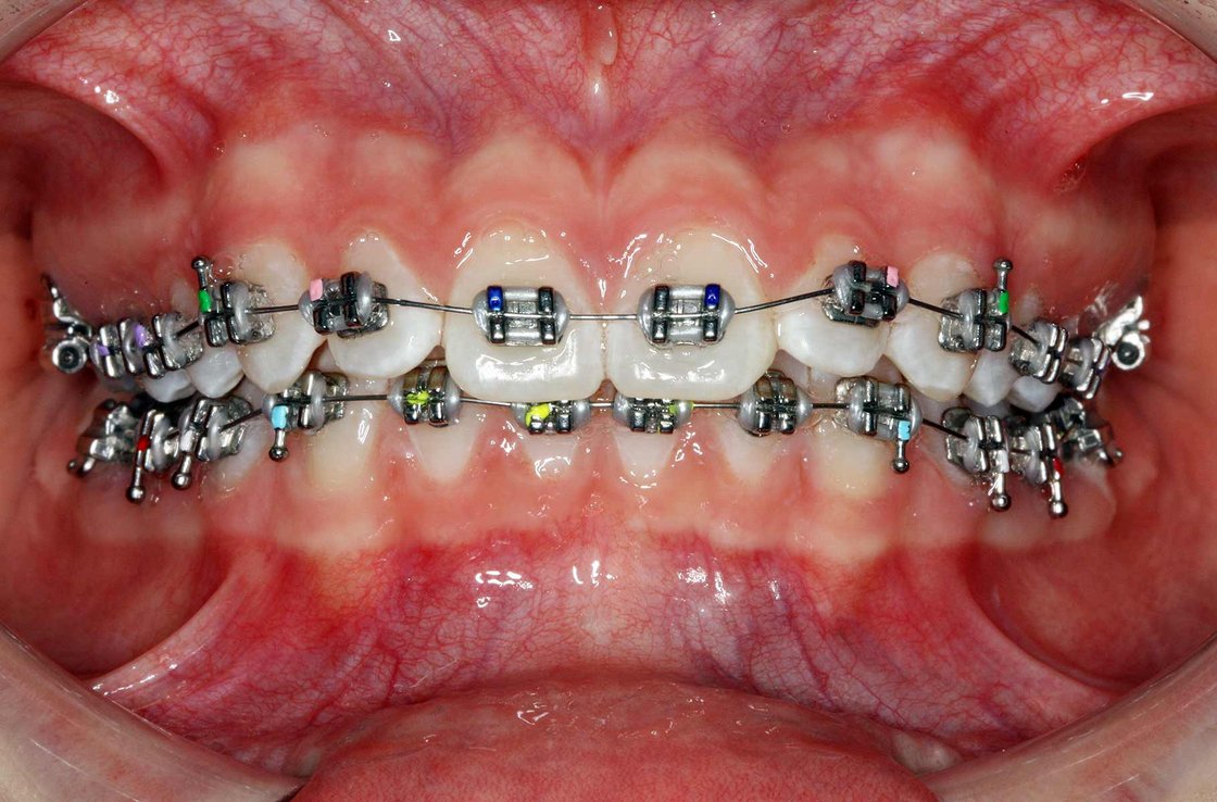 Abbildung: Beispiel von Metallbrackets