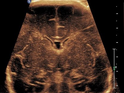 Ultraschallbild des Gehirns eines Kindes