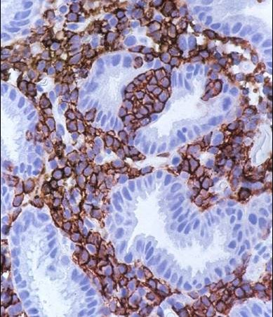 MALT-Lymphom