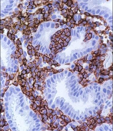 MALT-Lymphom