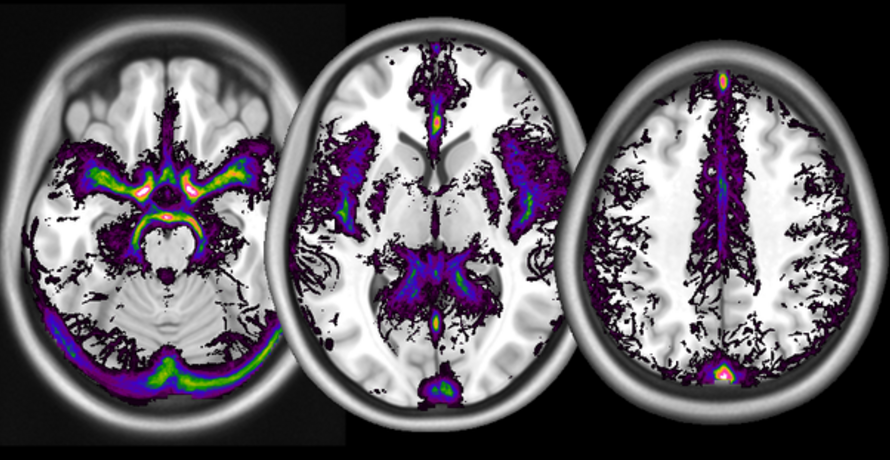 A digital atlas of the frequency of occurrence of large vessels (arterial as well as venous), computed from a database of time-of-flight images, overlaid on a template structural image from the MNI