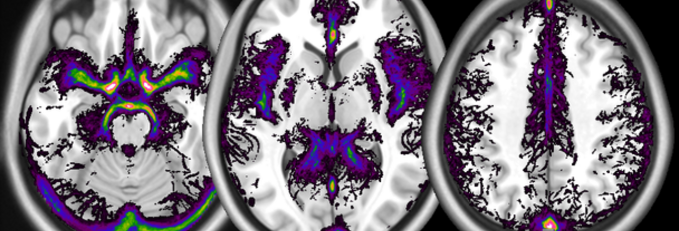 A digital atlas of the frequency of occurrence of large vessels (arterial as well as venous), computed from a database of time-of-flight images, overlaid on a template structural image from the MNI