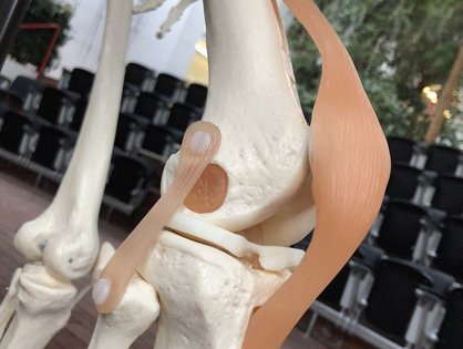 Weltweit leiden Millionen Menschen an Kniearthrose (Symbolbild: Prof. Lutz Dürselen)