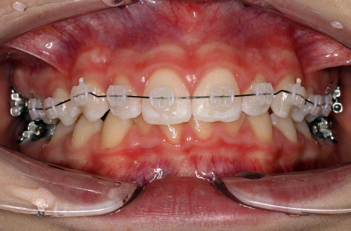 Abbildung: Beispiel von  Keramikbrackets 